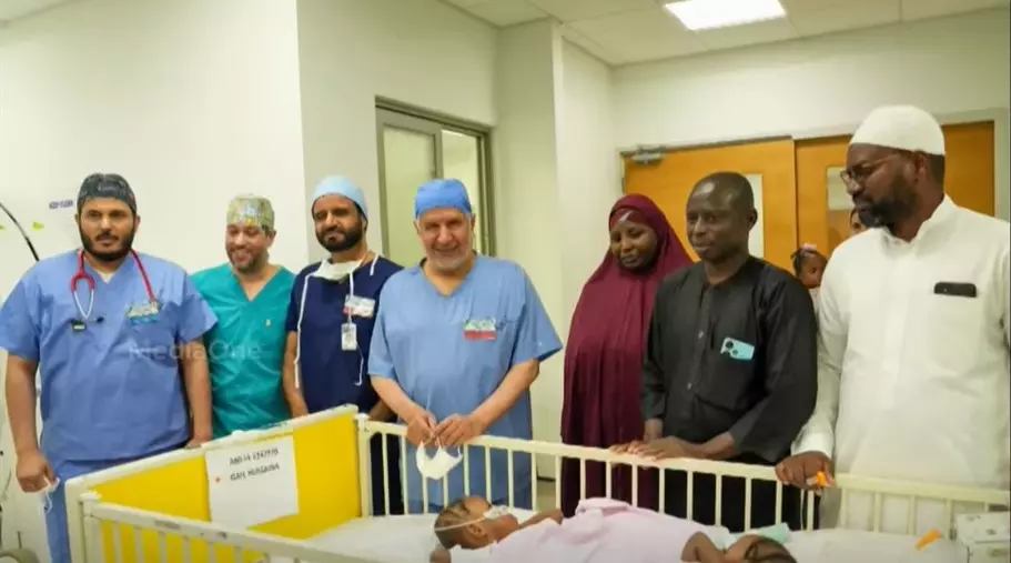 ഹസ്നയും ഹസീനയും ഇരുമെയ്യായി; സൗദിയിൽ നൈജീരിയൻ സയാമീസ് ഇരട്ടകളുടെ ശസ്ത്രക്രിയ വിജയകരം