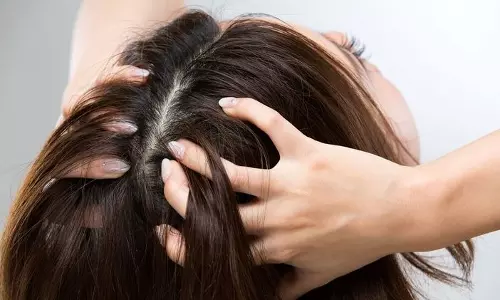 കഠിനമായ തല ചൊറിച്ചിൽ, താരനെന്ന് തെറ്റിദ്ധരിക്കേണ്ട; സ്കാൽപ് സോറിയാസിസാകാം