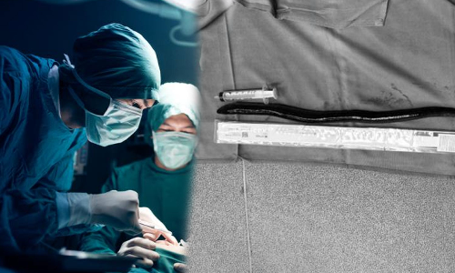 Live 12-inch eel removed from Vietnamese man, Live 12-inch eel ,Vietnamese,health,ജീവനുള്ള ഈല്‍,അപൂര്‍വരോഗാവസ്ഥ,വയറില്‍ ഈല്‍,വിയറ്റ്നാം