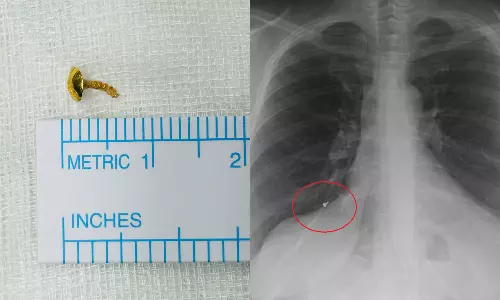 Part of the nostril which was missing 12 years ago was recovered from the lung