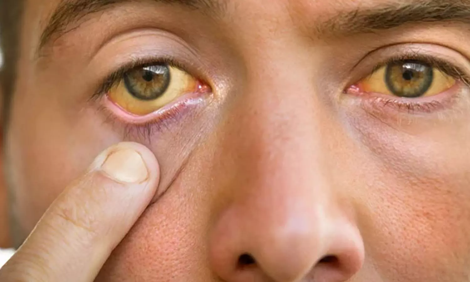 Kozhikode Changaroth spreads yellow fever; 41 children of the North School have been diagnosed with the disease, latest news malayalam, കോഴിക്കോട് ചങ്ങരോത്ത് മഞ്ഞപ്പിത്തം പടരുന്നു; വടക്കുമ്പാട് സ്കൂളിലെ 41 കുട്ടികൾക്ക് രോഗം സ്ഥിരീകരിച്ചു