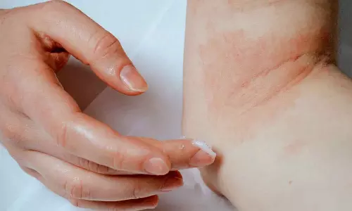 Long showers might trigger eczema