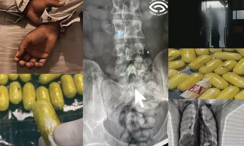 ശരീരത്തിനുള്ളിൽ ലഹരിമരുന്ന് ഒളിപ്പിച്ച യാത്രക്കാരൻ ഖത്തറില്‍ പിടിയിൽ