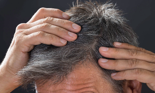 യൗവ്വനത്തിലെ അകാലനര; ഭക്ഷണം മുതൽ മാനസിക സമ്മർദം വരെ കാരണങ്ങൾ