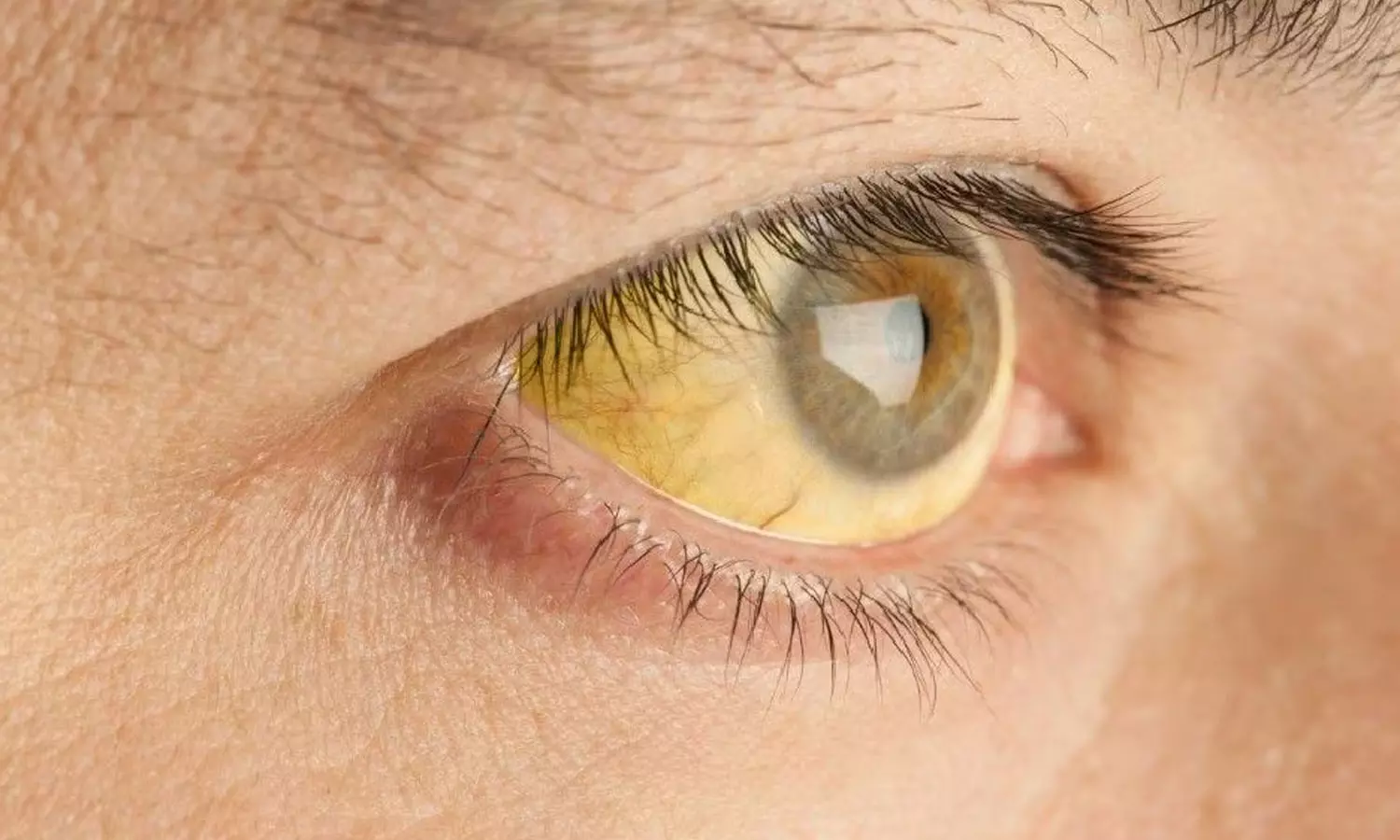 hepatitis ,vallikunnu,Malappuram,health news malayalam,latest malayalam news,വള്ളിക്കുന്നില് മഞ്ഞപ്പിത്തം പടരുന്നു,മഞ്ഞപിത്തം, hepatitis ,vallikunnu,Malappuram,health news malayalam,latest malayalam news,വള്ളിക്കുന്നില് മഞ്ഞപ്പിത്തം പടരുന്നു,മഞ്ഞപിത്തം,