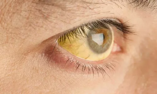 hepatitis ,vallikunnu,Malappuram,health news malayalam,latest malayalam news,വള്ളിക്കുന്നില്‍ മഞ്ഞപ്പിത്തം പടരുന്നു,മഞ്ഞപിത്തം,