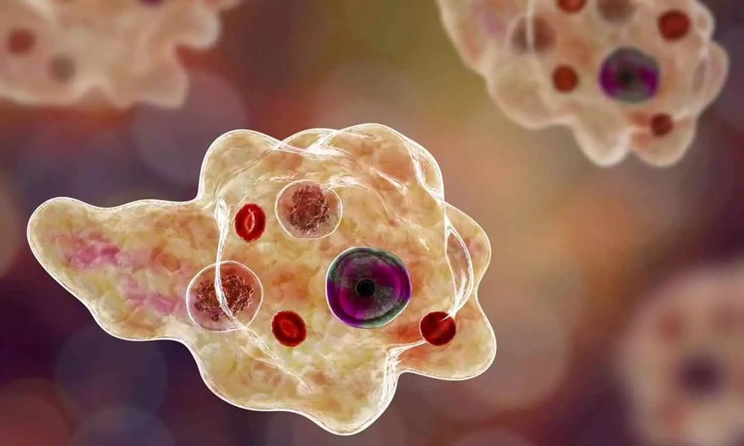 Amoebic meningoencephalitis, kozhikode native cured