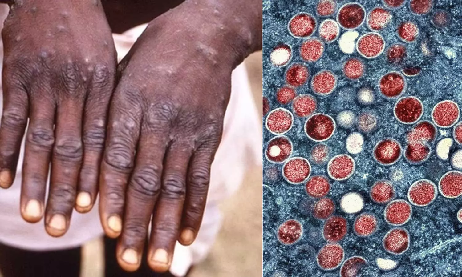 Empox in India: What are the symptoms and how to prevent? Learn more about the virus, latest news malayalam, ഇന്ത്യയിലും എംപോക്സ്: ലക്ഷണങ്ങൾ എന്തൊക്കെ?, എങ്ങനെ പ്രതിരോധിക്കും? വൈറസിനെ കുറിച്ച് കൂടുതലറിയാം