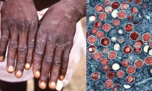 Empox in India: What are the symptoms and how to prevent? Learn more about the virus, latest news malayalam, ഇന്ത്യയിലും എംപോക്സ്: ലക്ഷണങ്ങൾ എന്തൊക്കെ?, എങ്ങനെ പ്രതിരോധിക്കും? വൈറസിനെ കുറിച്ച് കൂടുതലറിയാം