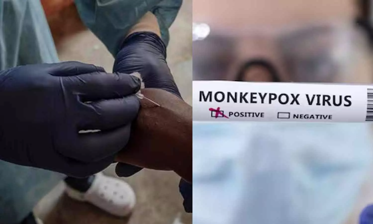 മങ്കി പോക്‌സ്: ഇന്ത്യയിൽ ആശങ്കപ്പെടേണ്ട സാഹചര്യമില്ല; ജാഗ്രതാ നിർദേശം