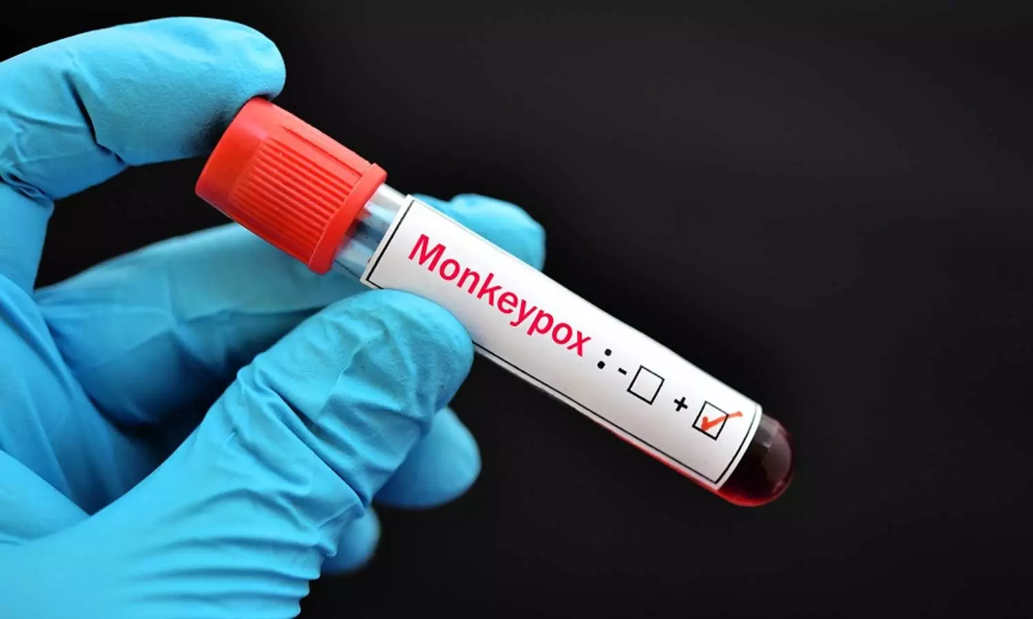 വിദേശത്ത് നിന്നെത്തിയ യുവാവിന് മങ്കിപോക്സ് ലക്ഷണം