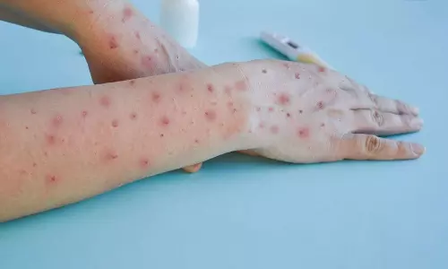 എം പോക്സ്: അറിയേണ്ടതെല്ലാം