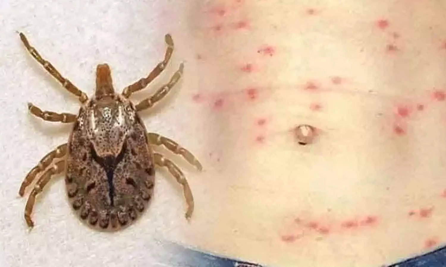 Murine typhus confirmed in the state; A resident of Thiruvananthapuram has been diagnosed with a disease similar to flea fever. latest news malayalam, സംസ്ഥാനത്ത് മുറിൻ ടൈഫസ് സ്ഥിരീകരിച്ചു; ചെള്ള് പനിക്ക് സമാനമായ രോഗം സ്ഥിരീകരിച്ചത് തിരുവനന്തപുരം സ്വദേശിക്ക്