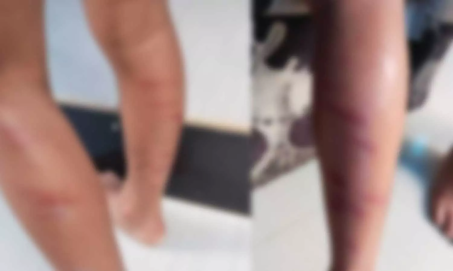 ഡയറി എഴുതിയില്ല; തൃശൂരിൽ അഞ്ചുവയസ്സുകാരനെ ടീച്ചർ തല്ലിച്ചതച്ചെന്ന് പരാതി