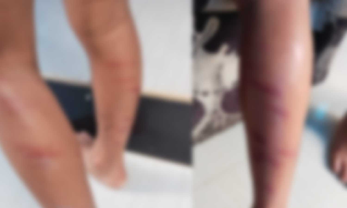 ഡയറി എഴുതിയില്ല; തൃശൂരിൽ അഞ്ചുവയസ്സുകാരനെ ടീച്ചർ തല്ലിച്ചതച്ചെന്ന് പരാതി