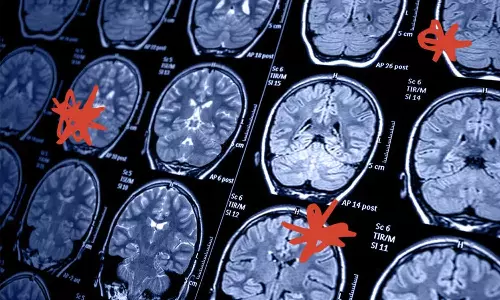 സ്ട്രോക്ക് അഥവാ പക്ഷാഘാതം; അറിയേണ്ടതെല്ലാം