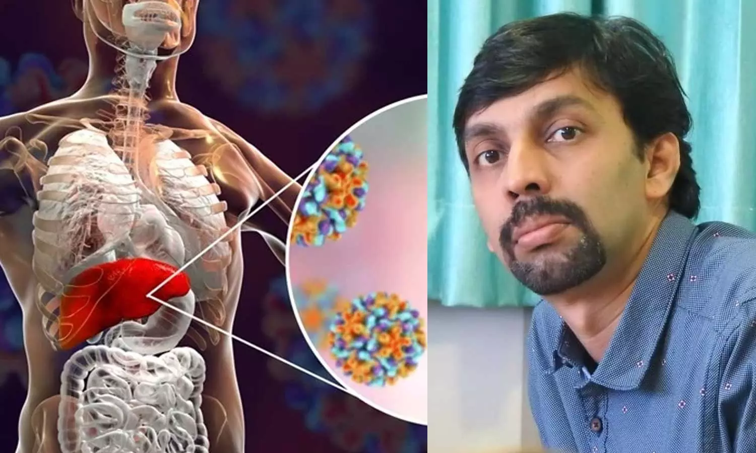 Doctors social media post alarms the dangerous nature of Hepatitis A that spreads in the state without any control, Hepatitis symptoms, How to prevent Hepatitis A, Hepatitis causes, Kozhikode medical college, Dr. Shameer VK