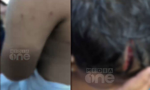 കൊല്ലത്ത് തെരുവ് നായ ആക്രമണം; മൂന്ന് വയസുകാരിക്ക് പരിക്ക്