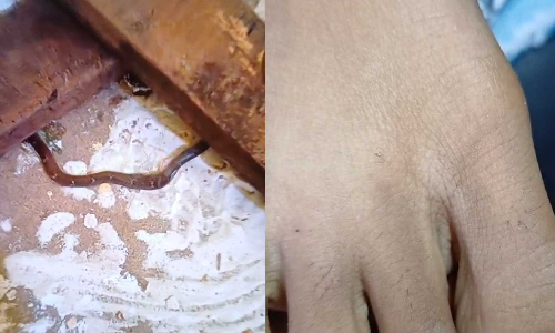 തിരുവനന്തപുരത്ത്​ സ്​കൂളിൽ ഏഴാം ക്ലാസുകാരിക്ക്​ പാമ്പു കടിയേറ്റു