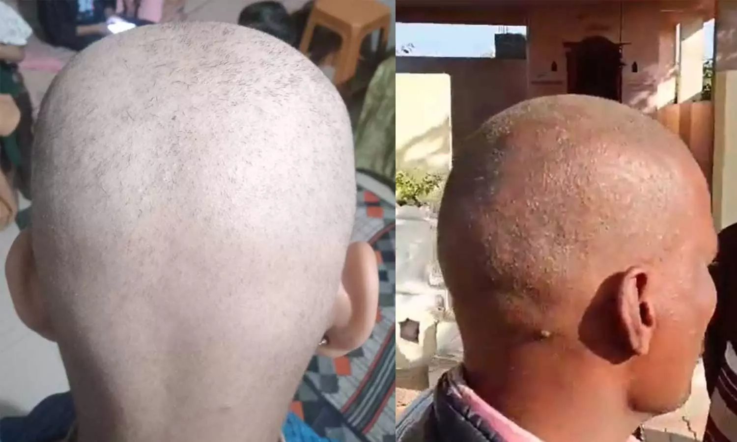 ഒരു സുപ്രഭാതത്തിൽ മുടികൊഴിയും, ദിവസങ്ങൾക്കുള്ളിൽ മൊട്ടയാവും; അപൂർവ പ്രതിഭാസത്തിൽ ഞെട്ടി ഗ്രാമീണർ ഒരു സുപ്രഭാതത്തിൽ മുടികൊഴിയും, ദിവസങ്ങൾക്കുള്ളിൽ മൊട്ടയാവും; അപൂർവ പ്രതിഭാസത്തിൽ ഞെട്ടി ഗ്രാമീണർ