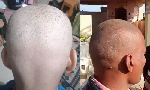 ഒരു സുപ്രഭാതത്തിൽ മുടികൊഴിയും,  ദിവസങ്ങൾക്കുള്ളിൽ മൊട്ടയാവും; അപൂർവ പ്രതിഭാസത്തിൽ ഞെട്ടി ഗ്രാമീണർ