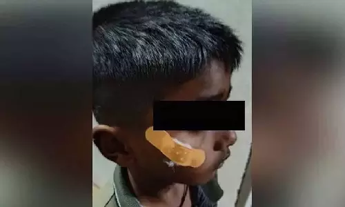 ഏഴ് വയസുകാരന്റെ മുറിവിൽ തുന്നലിടുന്നതിന് പകരം പശ വെച്ച് ഒട്ടിച്ചു ; കർണാടകയിൽ നഴ്സിന് സസ്പെൻഷൻ