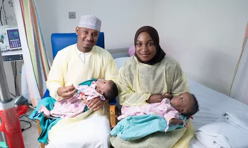 ഒമാനിൽ ആദ്യമായി സയാമീസ് ഇരട്ടകളെ വേർപ്പെടുത്തി; 19 മണിക്കൂർ നീണ്ട ശസ്ത്രക്രിയ വിജയകരം