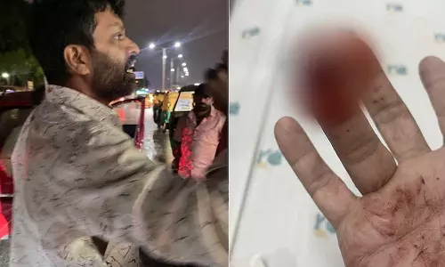 കാറിൽ മഴവെള്ളം തെറിപ്പിച്ചതിന് യുവാവിന്റെ വിരലിന് കടിച്ച് പരിക്കേൽപിച്ചു