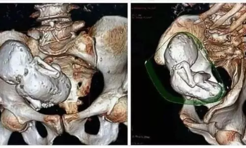 lithopedion