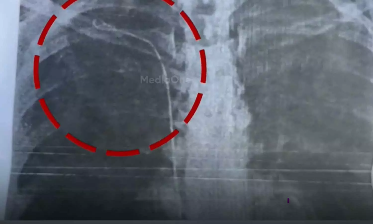 രോഗിയുടെ നെഞ്ചിൽ സർജിക്കൽ ട്യൂബ് കുടുങ്ങി; ശസ്ത്രക്രിയാ പിഴവ് സമ്മതിച്ച് ഡോക്ടർ, ശബ്ദരേഖ പുറത്ത് രോഗിയുടെ നെഞ്ചിൽ സർജിക്കൽ ട്യൂബ് കുടുങ്ങി; ശസ്ത്രക്രിയാ പിഴവ് സമ്മതിച്ച് ഡോക്ടർ, ശബ്ദരേഖ പുറത്ത്