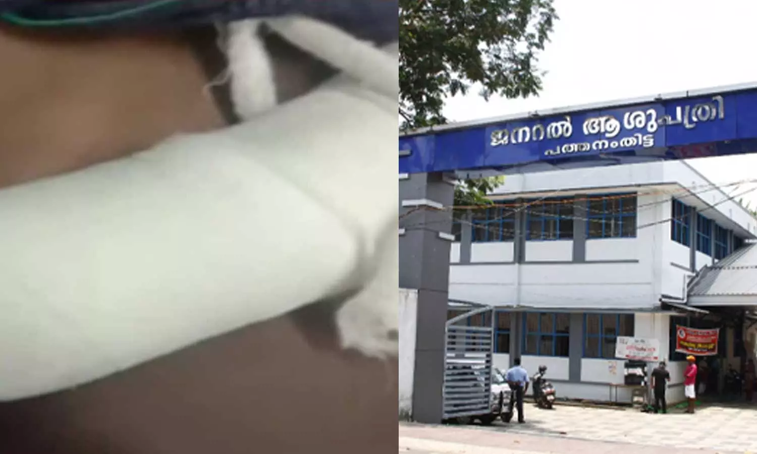 കുട്ടിയുടെ കയ്യിലെ ചതവ് ചികിത്സിക്കാതെ പ്ലാസ്റ്ററിട്ടു, മുറിവ് പഴുത്ത് വ്രണമായി; പത്തനംതിട്ട ജന. ആശുപത്രിക്കെതിരെ ചികിത്സാപിഴവ് ആരോപണം കുട്ടിയുടെ കയ്യിലെ ചതവ് ചികിത്സിക്കാതെ പ്ലാസ്റ്ററിട്ടു, മുറിവ് പഴുത്ത് വ്രണമായി; പത്തനംതിട്ട ജന. ആശുപത്രിക്കെതിരെ ചികിത്സാപിഴവ് ആരോപണം