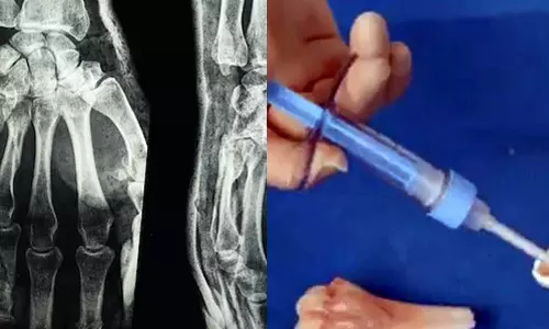 Chinese Scientists Create Bone Glue That Repairs Fractures In Just 3 Minutes