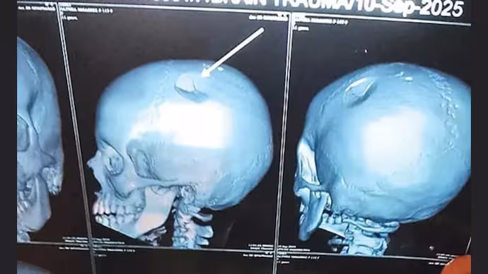 ക്ലാസിൽ മോശമായി പെരുമാറിയെന്ന് ആരോപണം; അധ്യാപിക ലഞ്ച് ബോക്സ് അടങ്ങിയ ബാഗ് കൊണ്ട് ആറാം ക്ലാസുകാരിയുടെ തലക്കടിച്ചു, തലയോട്ടിക്ക് പരിക്ക് ക്ലാസിൽ മോശമായി പെരുമാറിയെന്ന് ആരോപണം; അധ്യാപിക ലഞ്ച് ബോക്സ് അടങ്ങിയ ബാഗ് കൊണ്ട് ആറാം ക്ലാസുകാരിയുടെ തലക്കടിച്ചു, തലയോട്ടിക്ക് പരിക്ക്