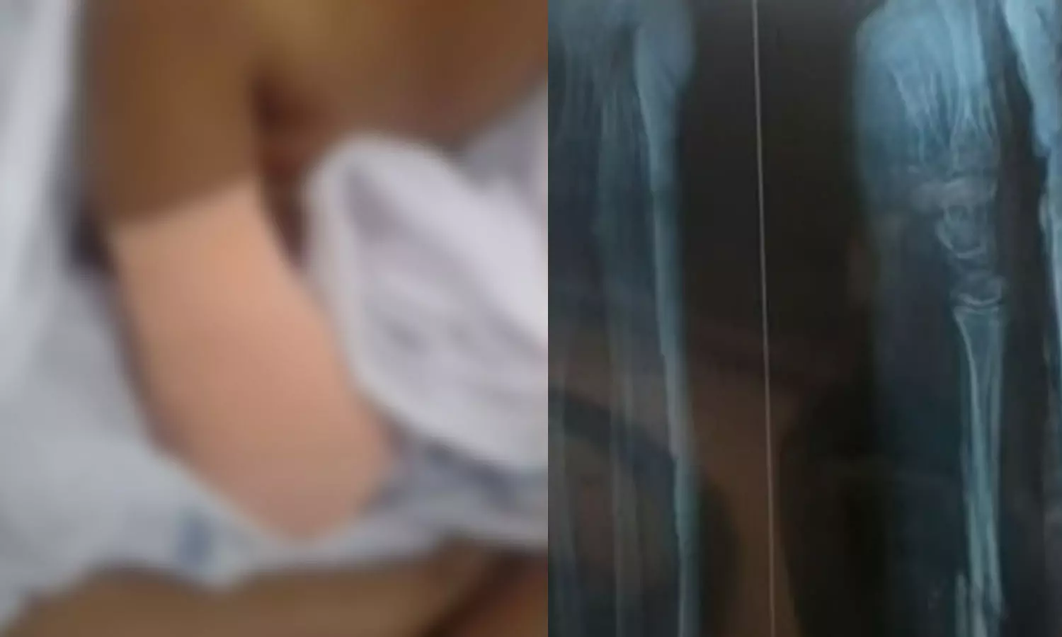 ഒൻപത് വയസുകാരിയുടെ കൈ മുറിച്ചു മാറ്റിയത് ചികിത്സാ പിഴവ്; പാലക്കാട് ജില്ലാ ആശുപത്രിക്കെതിരെ പരാതി