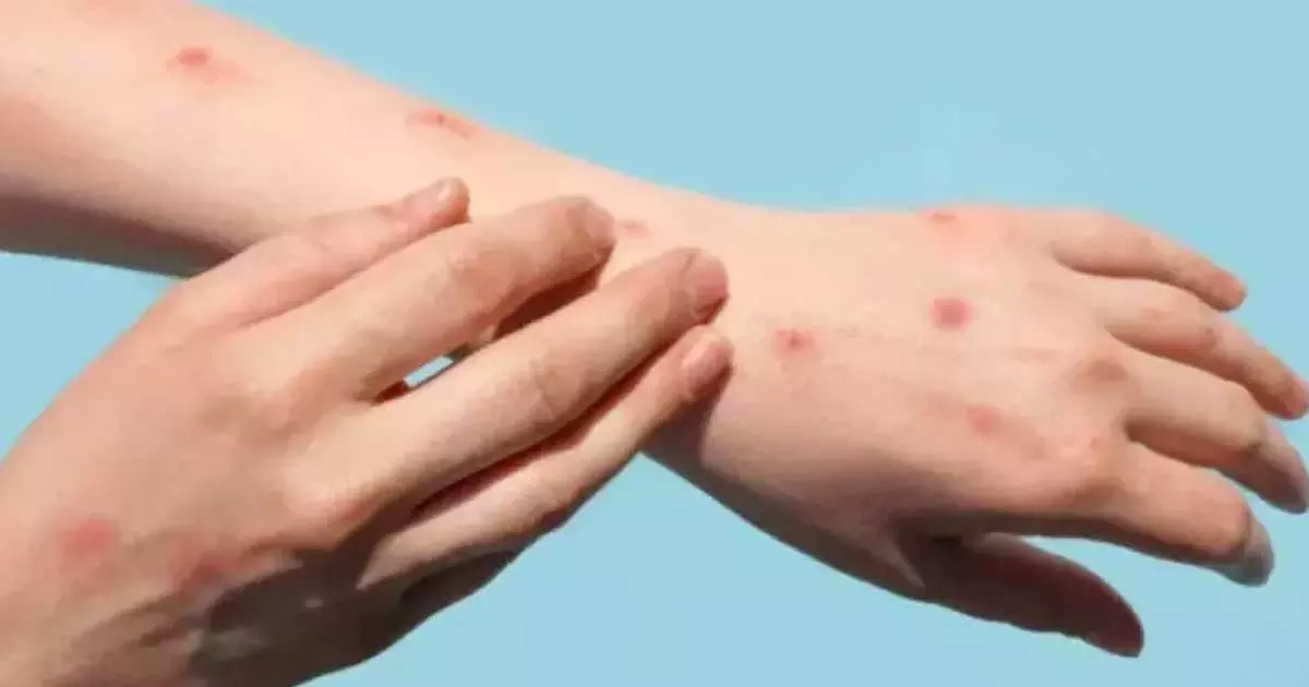 മങ്കിപോക്‌സ്; ജാഗ്രത നിർദേശം നൽകി ഒമാൻ ആരോഗ്യ മന്ത്രാലയം