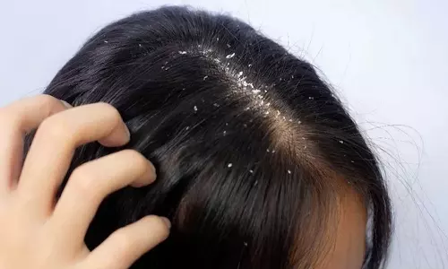 താരനുണ്ടോ? അവഗണിക്കരുത്; വിട്ടുമാറാത്ത താരന് പിന്നിലെ യഥാർഥ കാരണമറിയാം