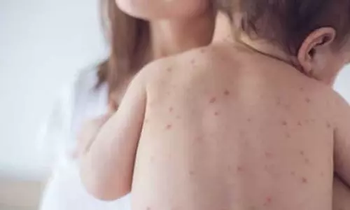 40 ദിവസത്തിനിടെ രോഗം ബാധിച്ചത് 5791 പേർക്ക്;  സംസ്ഥാനത്ത് ചിക്കൻപോക്സ് ബാധിതരുടെ എണ്ണം വർധിക്കുന്നു