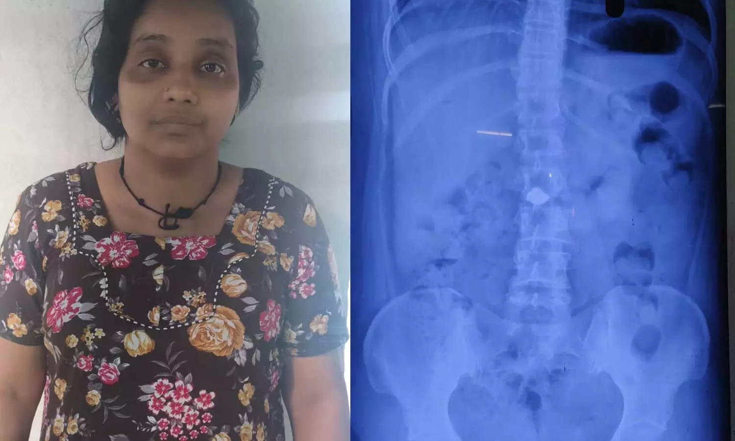 മാല വിഴുങ്ങിയതിന് പിടിയിലായി, സ്കാനിങ്ങിൽ യുവതിയുടെ വയറ്റിൽ കമ്മലും; തൊണ്ടിമുതലിനായി നാലു ദിവസമായി പൊലീസിന്റെ കാത്തിരിപ്പ് മാല വിഴുങ്ങിയതിന് പിടിയിലായി, സ്കാനിങ്ങിൽ യുവതിയുടെ വയറ്റിൽ കമ്മലും; തൊണ്ടിമുതലിനായി നാലു ദിവസമായി പൊലീസിന്റെ കാത്തിരിപ്പ്