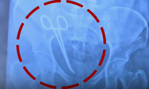 വണ്ടാനം മെഡി.കോളജിൽ വയറ്റിൽ കത്രിക കുടുങ്ങിയ സംഭവം: രണ്ട് പേർക്ക് സസ്‌പെൻഷൻ