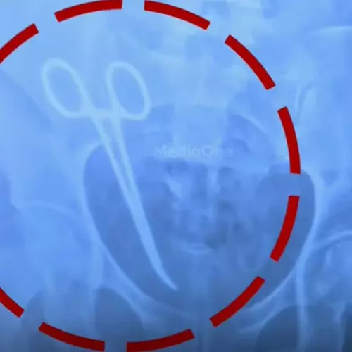 വണ്ടാനം മെഡി.കോളജിൽ വയറ്റിൽ കത്രിക കുടുങ്ങിയ സംഭവം: രണ്ട് പേർക്ക് സസ്‌പെൻഷൻ