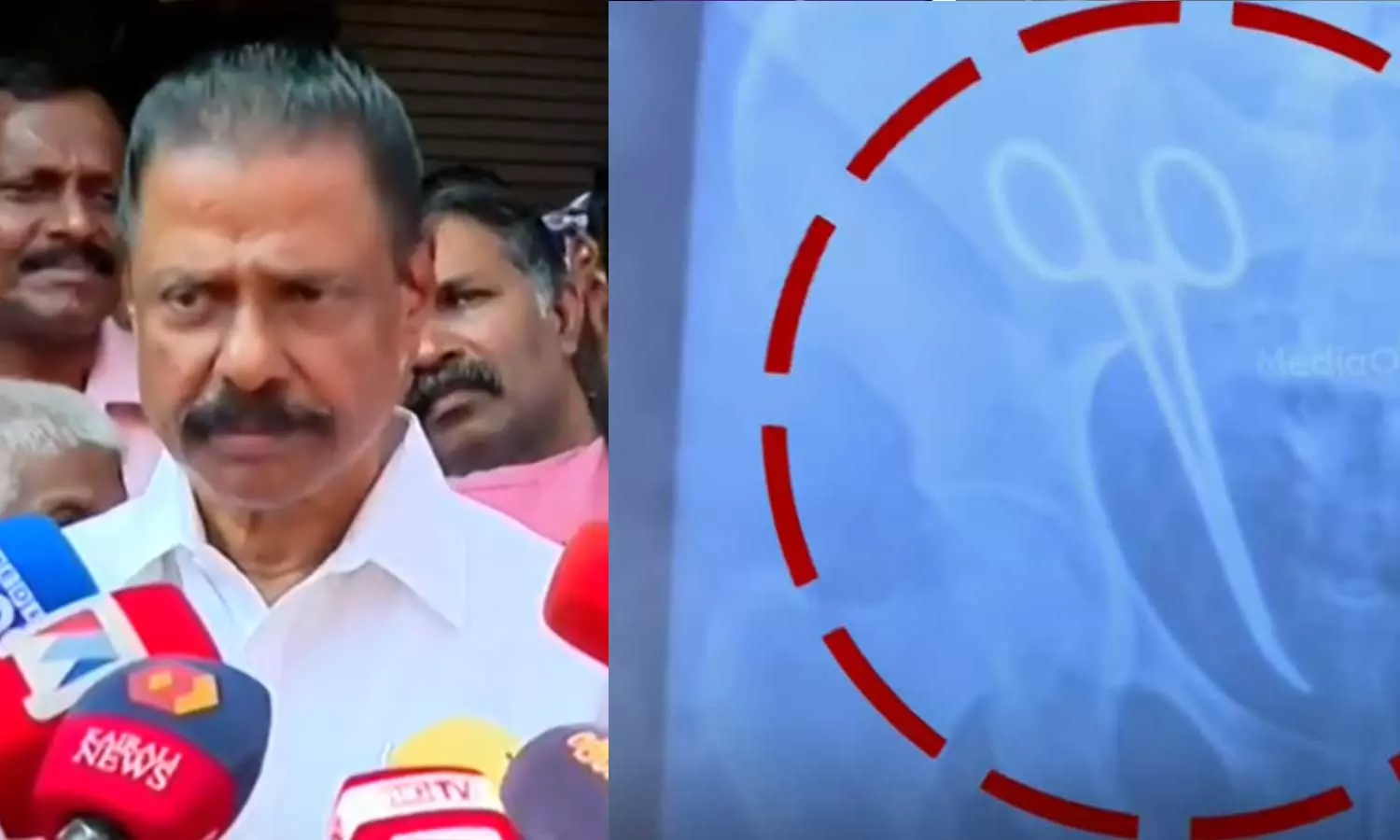 രോഗിയുടെ വയറ്റില് കത്രിക കുടുങ്ങിയത് ഒറ്റപ്പെട്ട സംഭവം, പര്വതീകരിക്കേണ്ടതില്ല; എം.വി ഗോവിന്ദന് രോഗിയുടെ വയറ്റില് കത്രിക കുടുങ്ങിയത് ഒറ്റപ്പെട്ട സംഭവം, പര്വതീകരിക്കേണ്ടതില്ല; എം.വി ഗോവിന്ദന്