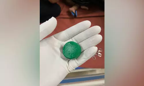 മലപ്പുറത്ത് 10 മാസം പ്രായമായ കുട്ടിയുടെ തൊണ്ടയിൽ ബോട്ടിൽ അടപ്പ് കുടുങ്ങി, പുറത്തെടുത്തു