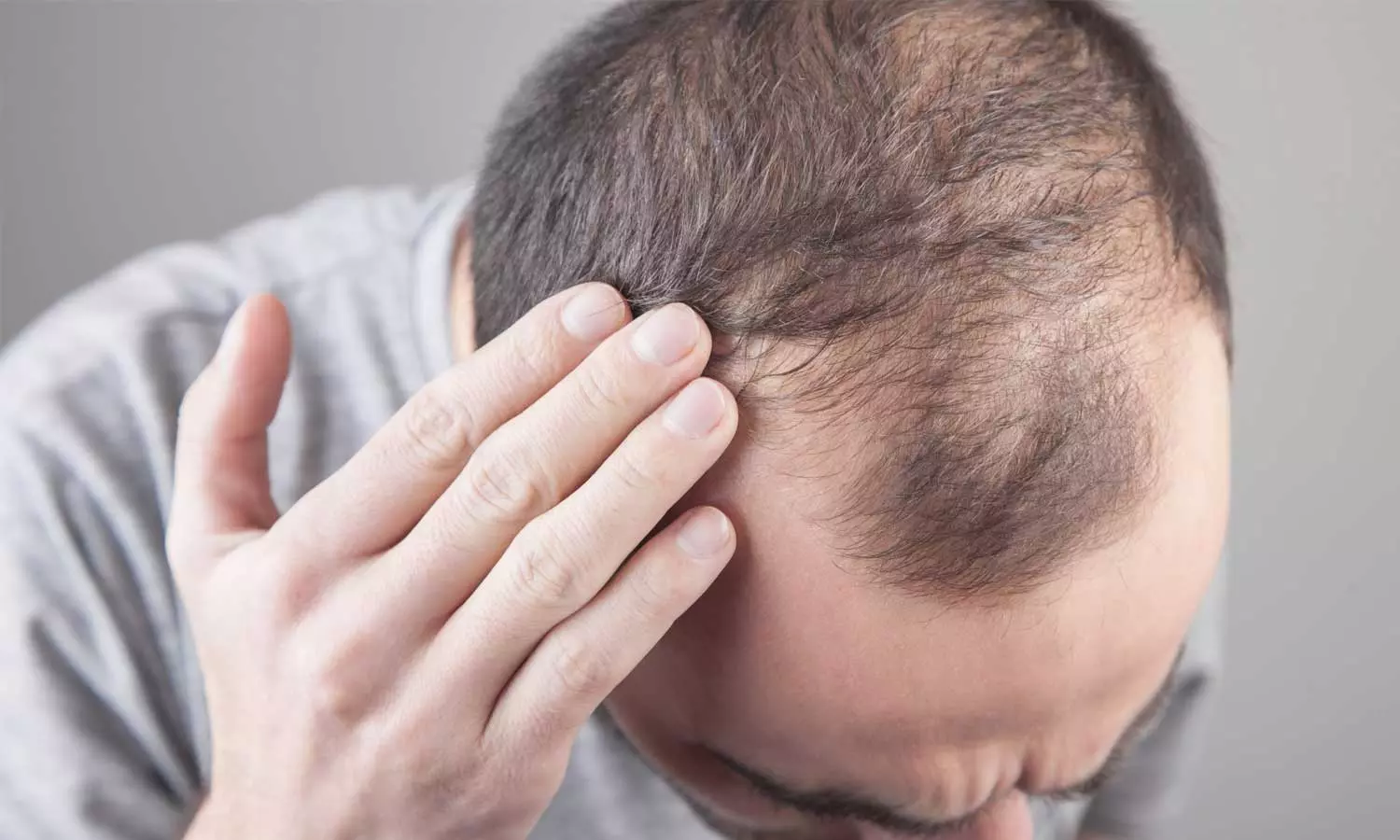 പാരമ്പര്യം മാത്രമല്ല, കഷണ്ടിക്ക് കാരണം ഈ ശീലവും പാരമ്പര്യം മാത്രമല്ല, കഷണ്ടിക്ക് കാരണം ഈ ശീലവും