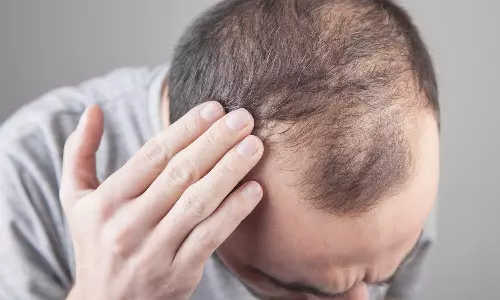 പാരമ്പര്യം മാത്രമല്ല, കഷണ്ടിക്ക് കാരണം ഈ ശീലവും പാരമ്പര്യം മാത്രമല്ല, കഷണ്ടിക്ക് കാരണം ഈ ശീലവും