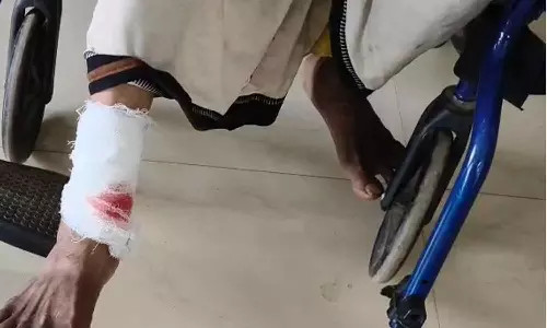 കോഴിക്കോട് രണ്ട് പേർക്ക് തെരുവ് നായയുടെ കടിയേറ്റു കോഴിക്കോട് രണ്ട് പേർക്ക് തെരുവ് നായയുടെ കടിയേറ്റു