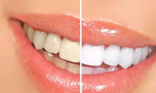 ബ്രഷ് ചെയ്തിട്ടും പല്ലിന് മഞ്ഞനിറം?; അറിയാം യഥാർഥ കാരണങ്ങൾ! ബ്രഷ് ചെയ്തിട്ടും പല്ലിന് മഞ്ഞനിറം?; അറിയാം യഥാർഥ കാരണങ്ങൾ!