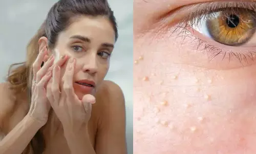 ചൊറിച്ചിലോ വേദനയോ ഉണ്ടാകില്ല; മുഖക്കുരുവെന്ന് തോന്നിക്കുന്ന വെളുത്ത കുരുക്കൾ; ചികിത്സിക്കേണ്ടതുണ്ടോ?, വിദഗ്ധർ പറയുന്നതിങ്ങനെ