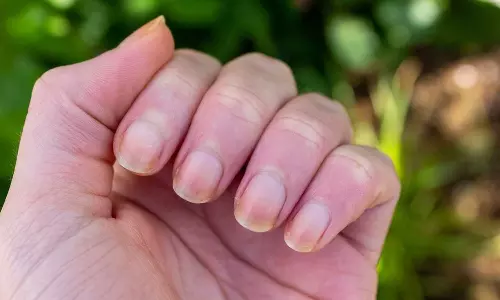 നഖത്തിൽ നിറവ്യത്യാസമോ തവിട്ടുവരകളോ ഉണ്ടോ? അവ​ഗണിക്കരുത്, ഈ രോ​ഗമാകാം