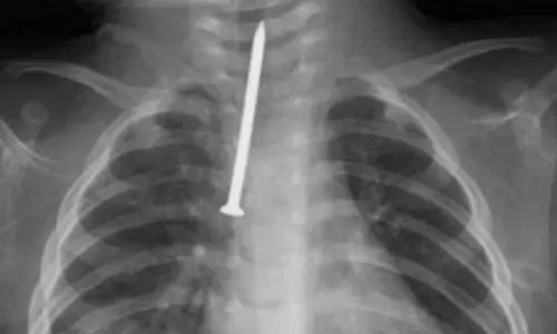Medical team saves baby who swallowed a 5-centimeter nail