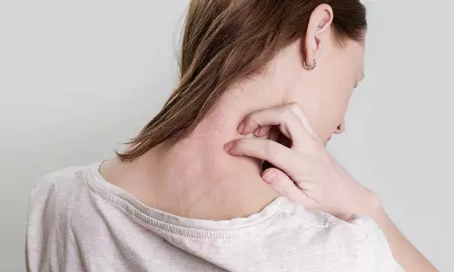 വേനൽക്കാലത്തെ ചൂടുകുരു മാറ്റാൻ പൗഡർ വേണ്ട; ഇതാ ഒരു കൂൾ പ്ലാൻ